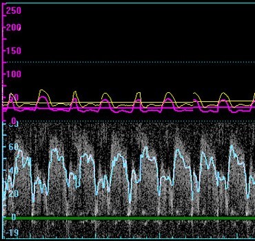 Heart monitor reading