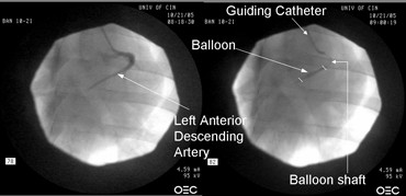 Diagnostic test showing angiographic evidence of stenosis