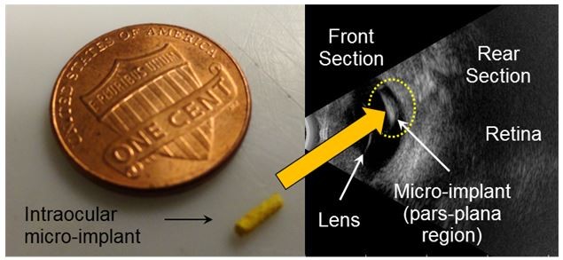 Ocular drug delivery, xray of eye