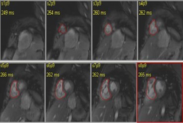 MRI of right ventricle