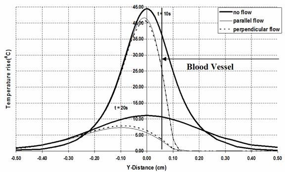 Graph of the temperature rise (oC) as a function of radial distance (cm) at t = 10 and 20 sec (ultrasound is turned off after 10 sec) for no flow, parallel flow, and perpendicular flow models.